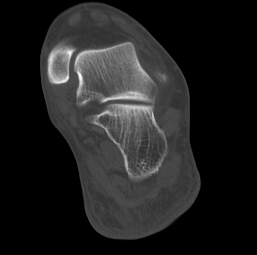 Anterior calcaneal process fracture (Radiopaedia 47384-51989 Coronal bone window 61).png
