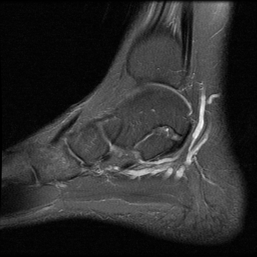 File:Anterior calcaneal process fracture (Radiopaedia 74654-85611 Sagittal PD fat sat 5).jpg