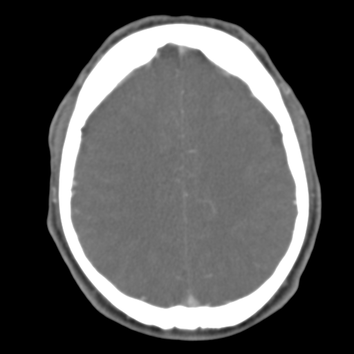 File:Anterior cerebral artery territory infarct (Radiopaedia 39327-41581 B 20).png