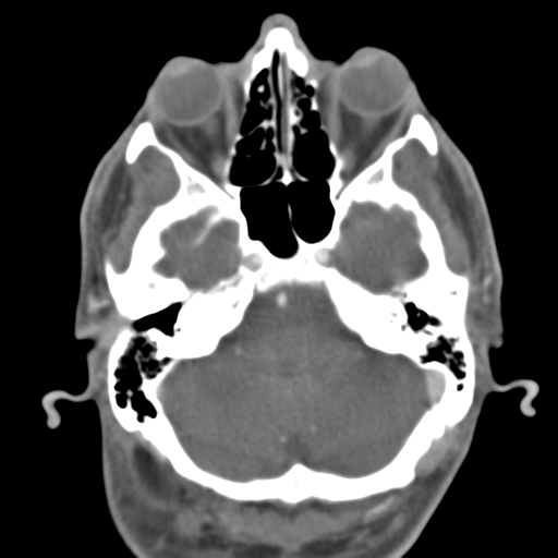 File:Anterior cerebral artery territory infarct (Radiopaedia 39327-41581 B 44).png