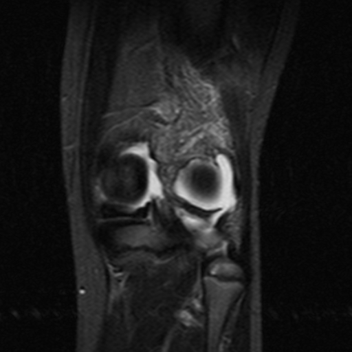 File:Anterior cruciate ligament avulsion fracture (Radiopaedia 24710-24974 Coronal STIR 10).jpg