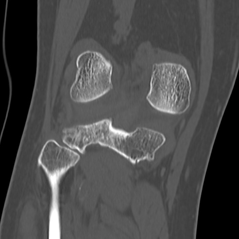 File:Anterior cruciate ligament avulsion fracture (Radiopaedia 58939-66194 Coronal bone window 25).jpg