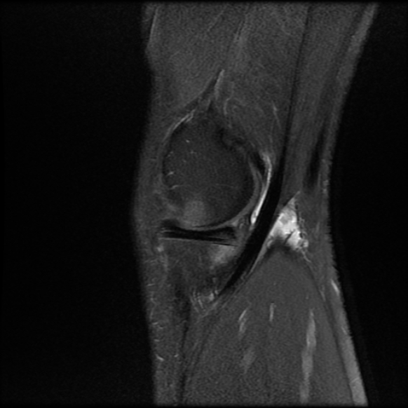 File:Anterior cruciate ligament graft tear and bucket-handle tear of medial meniscus (Radiopaedia 75867-87254 Sagittal PD fat sat 5).jpg