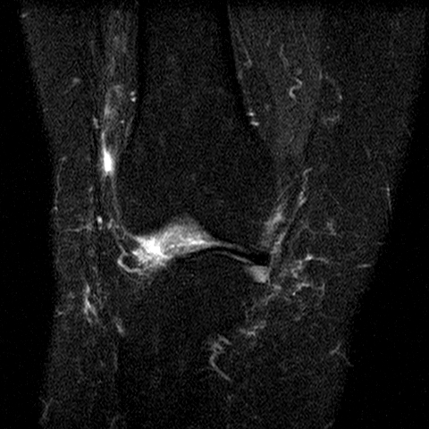File:Anterior cruciate ligament mucoid degeneration (Radiopaedia 60853-68633 Coronal STIR 14).jpg