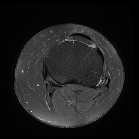 File:Anterior cruciate ligament tear, Wrisberg rip and bucket-handle tear of medial meniscus (Radiopaedia 75872-87266 Axial PD fat sat 6).jpg