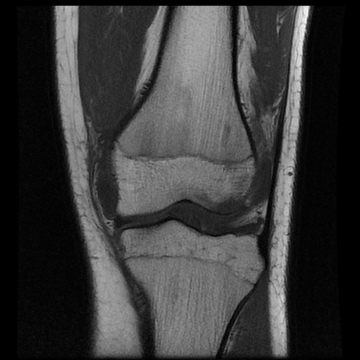 File:Anterior cruciate ligament tear (Radiopaedia 61500-69462 Coronal T1 9).jpg