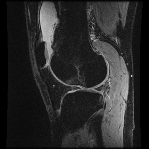 File:Anterior cruciate ligament tear (Radiopaedia 61500-69462 F 67).jpg