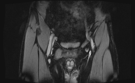 Anterior inferior iliac spine avulsion fracture (Radiopaedia 81312-95000 G 95).jpg