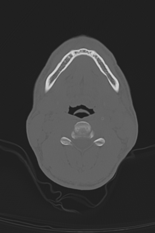 Anterior nasal spine fracture (Radiopaedia 46138-50494 Axial bone window 73).png