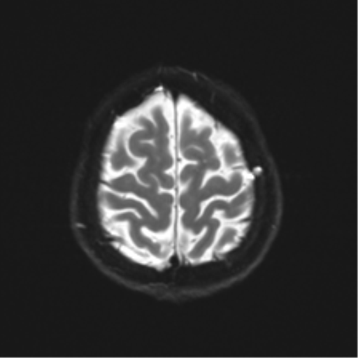 File:Anterior temporal lobe perivascular space (Radiopaedia 40946-43650 Axial DWI 24).png