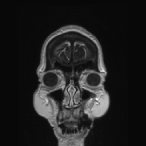 Anterior temporal pole cysts (Radiopaedia 46629-51102 Coronal T1 C+ 163).png