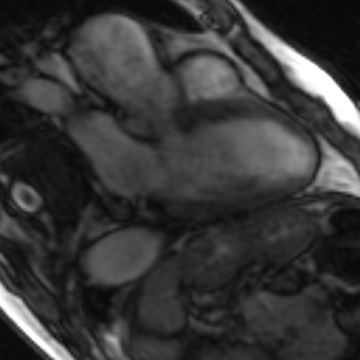 File:Anteroseptal hypokinesia after myocardial infarction (Radiopaedia 15978-15633 3 chamber view SSFE 1).jpg