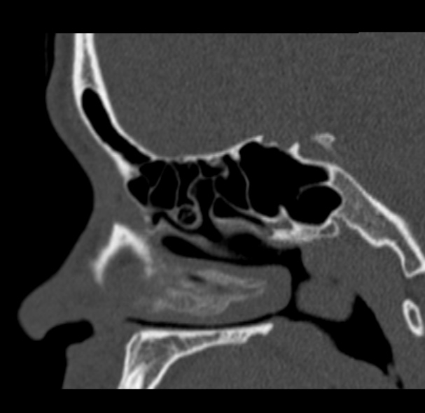File:Antrochoanal polyp (Radiopaedia 33984-35202 Sagittal bone window 49).jpg