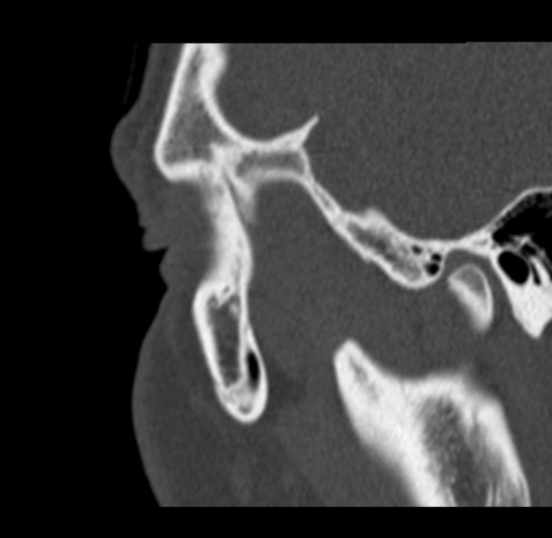 Antrochoanal polyp (Radiopaedia 33984-35202 Sagittal bone window 81).jpg