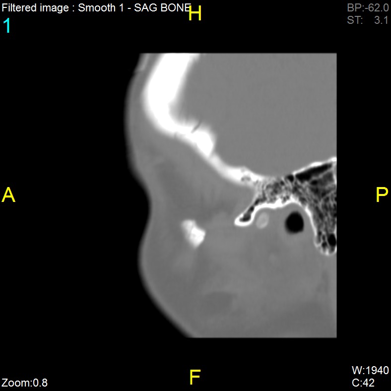Antrochoanal polyp (Radiopaedia 65101-74094 Sagittal bone window 1).jpg