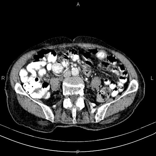 File:Aortic aneurysm and Lemmel syndrome (Radiopaedia 86499-102554 A 51).jpg