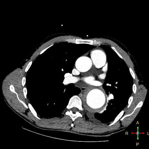 File:Aortic aneurysm and penetrating ulcer (Radiopaedia 23590-23704 A 17).jpg