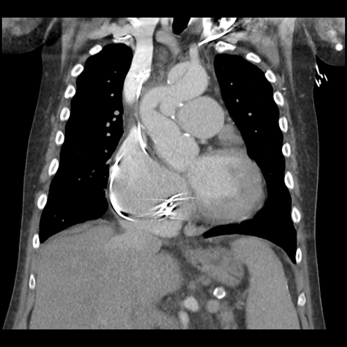 Aortic arch graft infection (FDG PET-CT) (Radiopaedia 71975-82437 Coronal 27).jpg