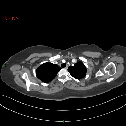 File:Aortic arch origin of left vertebral artery (Radiopaedia 51520-57286 A 42).jpg