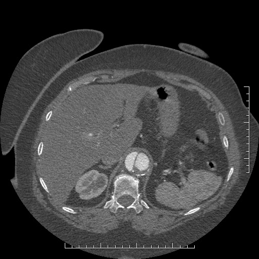Aortic dissection- Stanford A (Radiopaedia 35729-37268 B 36).jpg
