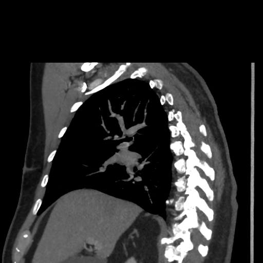 File:Aortic dissection- Stanford A (Radiopaedia 37759-39664 D 2).png