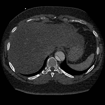 File:Aortic dissection (Radiopaedia 57969-64959 A 263).jpg