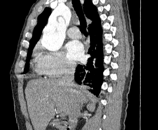 Aortic dissection - Stanford A -DeBakey I (Radiopaedia 28339-28587 C 10).jpg