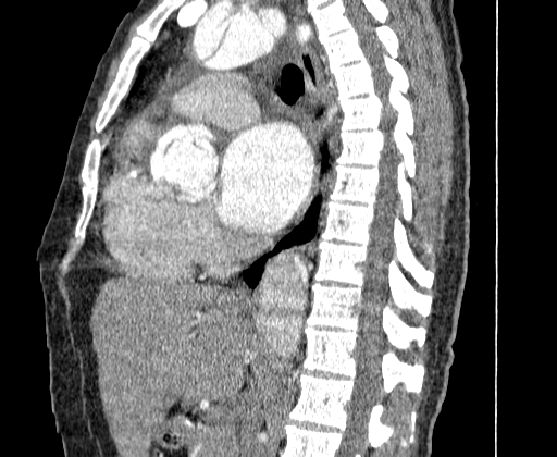 Aortic dissection - Stanford A -DeBakey I (Radiopaedia 28339-28587 C 28).jpg