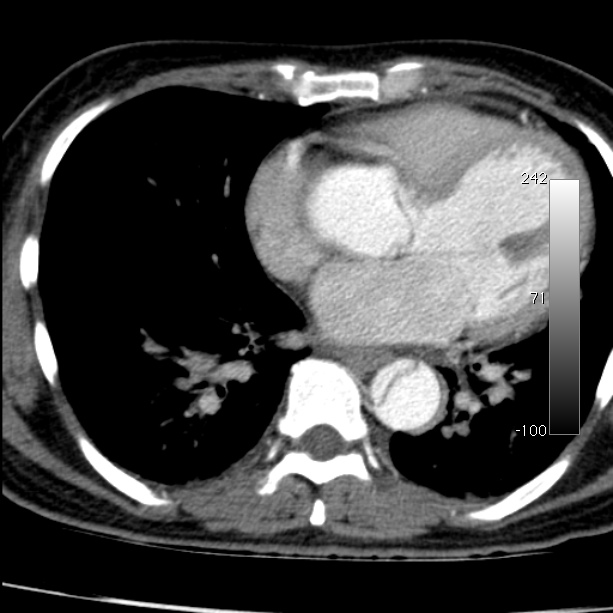 Aortic dissection - Stanford type A (Radiopaedia 29247-29659 A 50).jpg