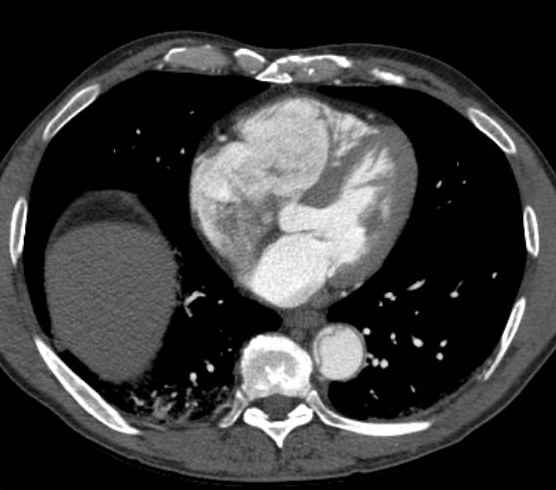 Aortic dissection - Stanford type B (Radiopaedia 73648-84437 A 75).jpg