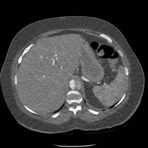 Aortic dissection - Stanford type B (Radiopaedia 88281-104910 A 93).jpg