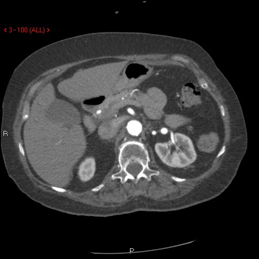 Aortic intramural hematoma (Radiopaedia 27746-28001 A 100).jpg
