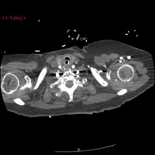 Aortic intramural hematoma (Radiopaedia 27746-28001 A 5).jpg