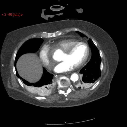 File:Aortic intramural hematoma (Radiopaedia 27746-28001 A 65).jpg
