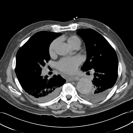 Aortic intramural hematoma (Radiopaedia 34260-35540 Axial non-contrast 34).png