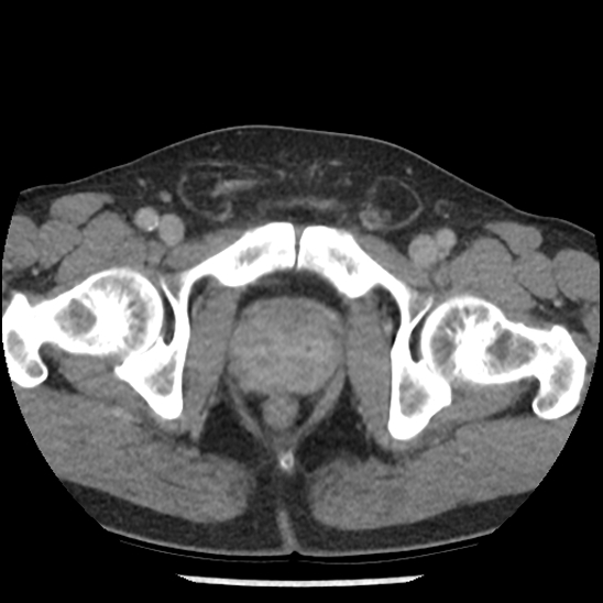 Aortic intramural hematoma (type B) (Radiopaedia 79323-92387 Axial C+ delayed 114).jpg