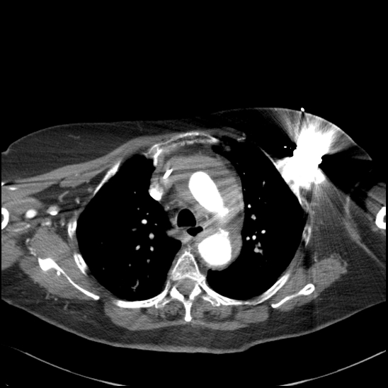 Aortic intramural hematoma with dissection and intramural blood pool (Radiopaedia 77373-89491 B 43).jpg