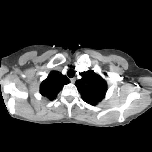 Aortic valve non-coronary cusp thrombus (Radiopaedia 55661-62189 B 7).png