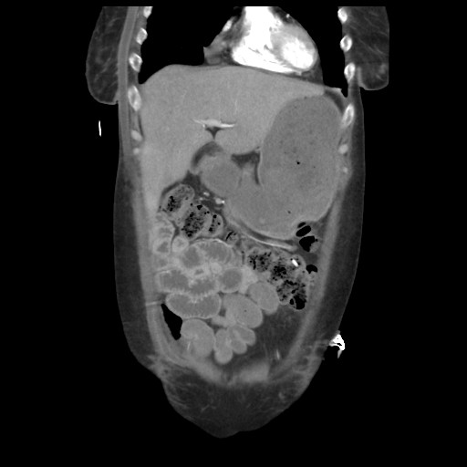 File:Aorto-duodenal fistula (Radiopaedia 25668-25850 B 14).jpg