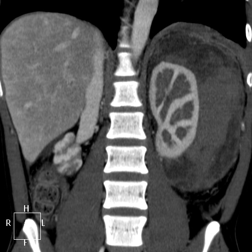 File:Aorto-left renal vein fistula (Radiopaedia 45534-49628 B 44).jpg