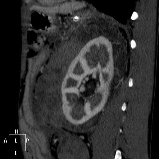 Aorto-left renal vein fistula (Radiopaedia 45534-49628 C 52).jpg
