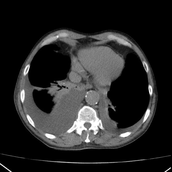 Aortoiliac occlusive disease (Radiopaedia 32134-33076 Axial non-contrast 4).jpg
