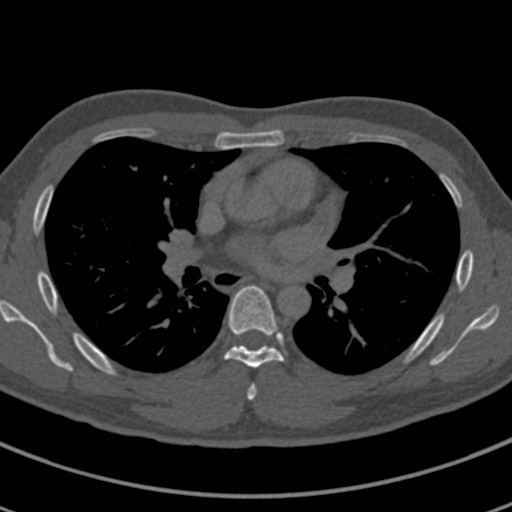 Apical lung mass mimic - neurogenic tumor (Radiopaedia 59918-67521 Axial bone window 40).jpg