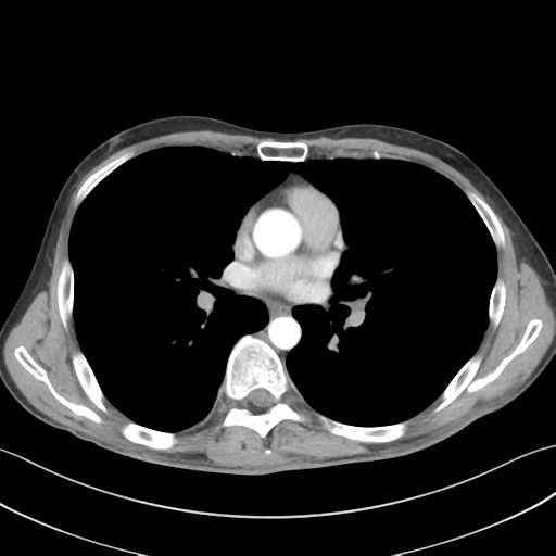 File:Apical pleural calcification (Radiopaedia 46141-50499 Axial C+ delayed 34).png
