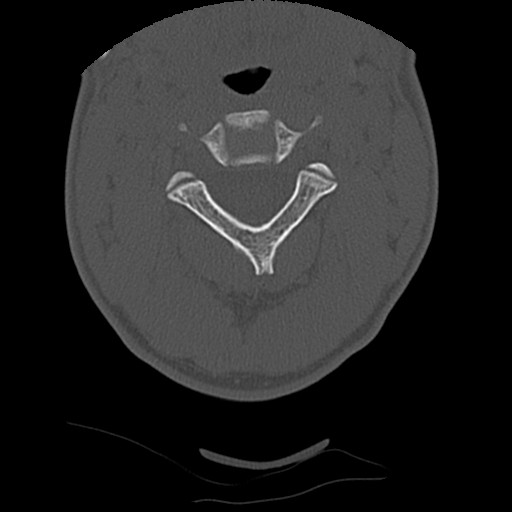 Apical pneumothorax on cervical spine CT (Radiopaedia 45343-49368 Axial bone window 28).jpg