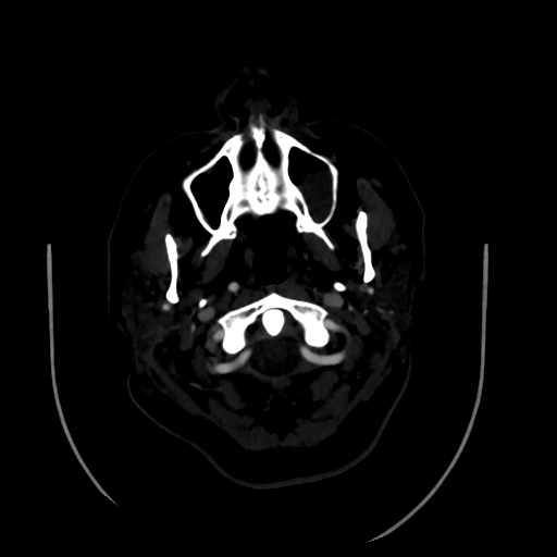 Aplasia of the internal carotid artery (Radiopaedia 61082-68960 A 4).jpg