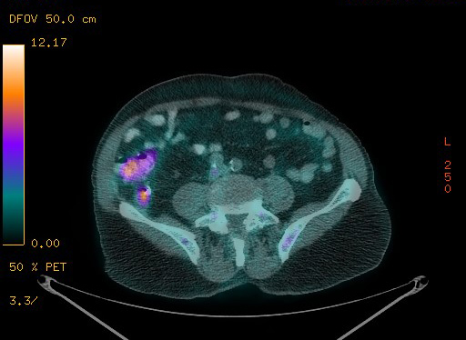 Appendiceal adenocarcinoma complicated by retroperitoneal abscess (Radiopaedia 58007-65041 Axial PET-CT 150).jpg