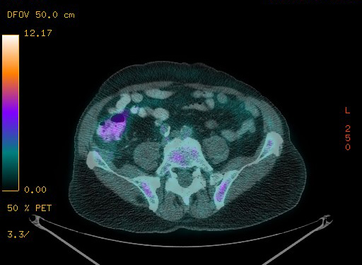 Appendiceal adenocarcinoma complicated by retroperitoneal abscess (Radiopaedia 58007-65041 Axial PET-CT 153).jpg