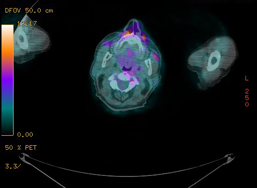 Appendiceal adenocarcinoma complicated by retroperitoneal abscess (Radiopaedia 58007-65041 Axial PET-CT 3).jpg