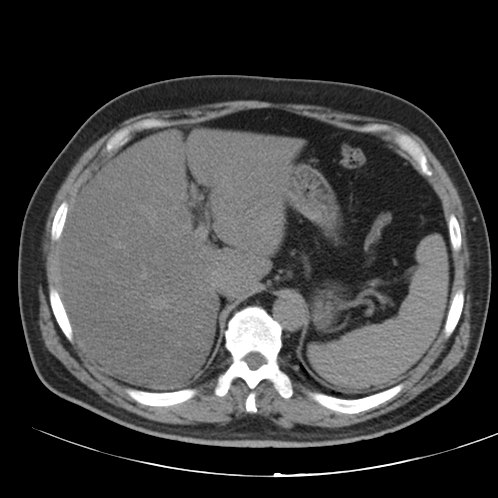 Appendicitis and giant appendicolith (Radiopaedia 80251-93588 Axial non-contrast 6).jpg